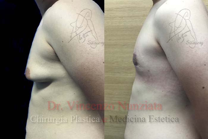 Ginecomastia prima e dopo – Paziente 2 – Dr. Vincenzo Nunziata, chirurgo plastico – foto 2