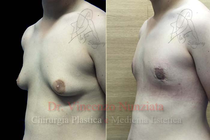 Ginecomastia prima e dopo – Paziente 2 – Dr. Vincenzo Nunziata, chirurgo plastico – foto 3