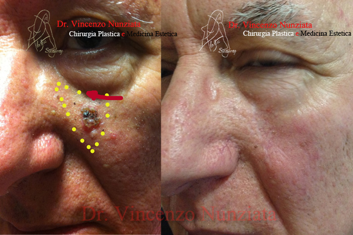 Chirurgia dei tumori cutanei prima e dopo – Tumori – Dr. Vincenzo Nunziata, chirurgo plastico