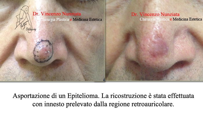 Chirurgia dei tumori cutanei prima e dopo – Tumori – Dr. Vincenzo Nunziata, chirurgo plastico – foto 6
