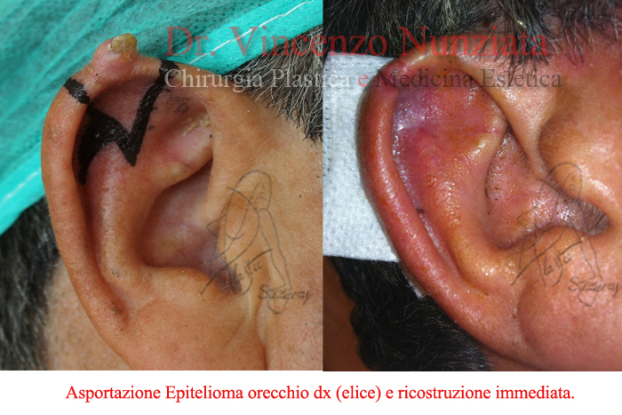 Chirurgia dei tumori cutanei prima e dopo – Tumori – Dr. Vincenzo Nunziata, chirurgo plastico – foto 7