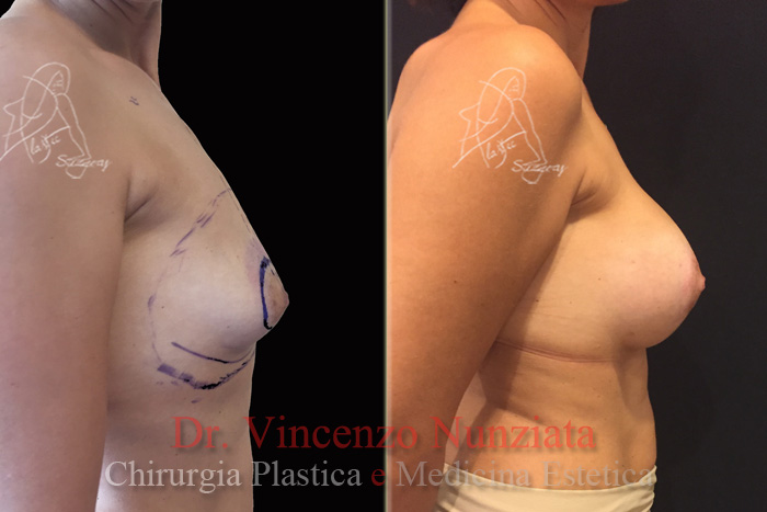 Asimmetrie mammarie prima e dopo – Paziente 2 – Dr. Vincenzo Nunziata, chirurgo plastico – foto 2