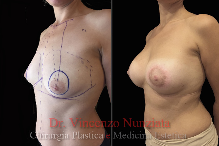 Asimmetrie mammarie prima e dopo – Paziente 2 – Dr. Vincenzo Nunziata, chirurgo plastico – foto 3