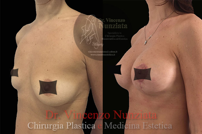 Asimmetrie mammarie prima e dopo – Paziente 1 – Dr. Vincenzo Nunziata, chirurgo plastico – foto 2
