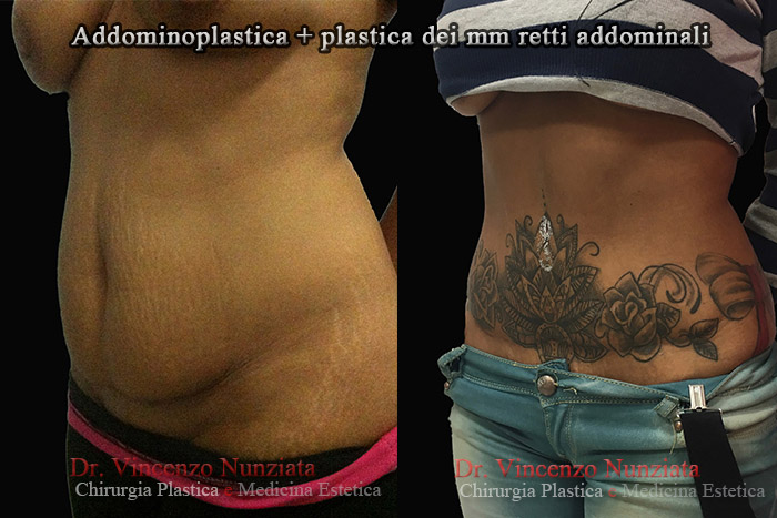 Addominoplastica prima e dopo – Paziente 12 – Dr. Vincenzo Nunziata, chirurgo plastico – foto 2