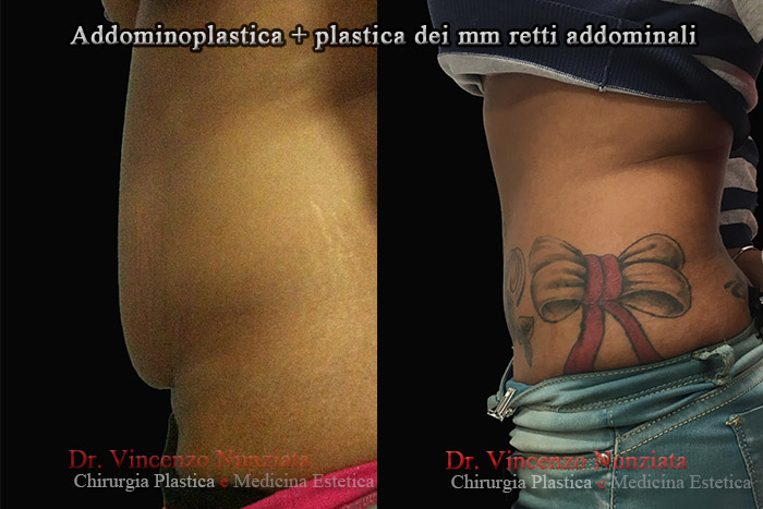 Addominoplastica prima e dopo – Paziente 12 – Dr. Vincenzo Nunziata, chirurgo plastico – foto 3
