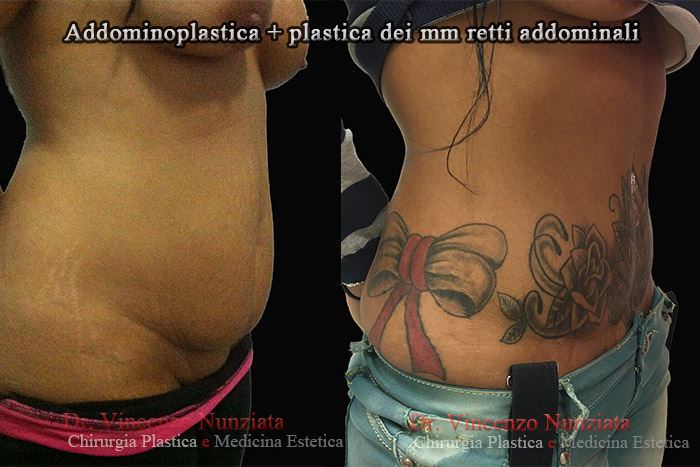 Addominoplastica prima e dopo – Paziente 12 – Dr. Vincenzo Nunziata, chirurgo plastico – foto 4