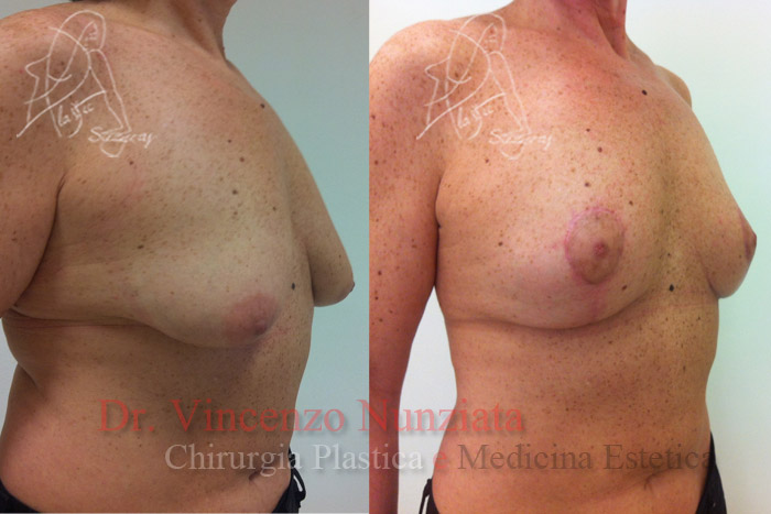 Mastopessi prima e dopo – Paziente 2 – Dr. Vincenzo Nunziata, chirurgo plastico – foto 2