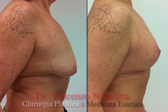 Mastopessi prima e dopo – Paziente 2 – Dr. Vincenzo Nunziata, chirurgo plastico – foto 3