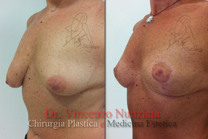 Mastopessi prima e dopo – Paziente 2 – Dr. Vincenzo Nunziata, chirurgo plastico – foto 4