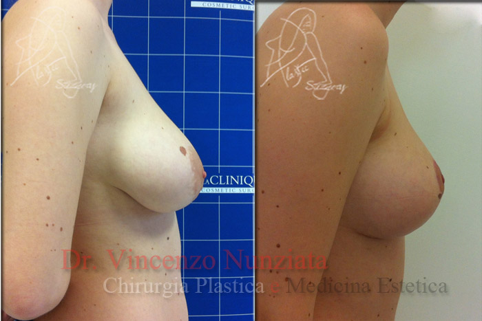 Mastopessi prima e dopo – Paziente 3 – Dr. Vincenzo Nunziata, chirurgo plastico – foto 3