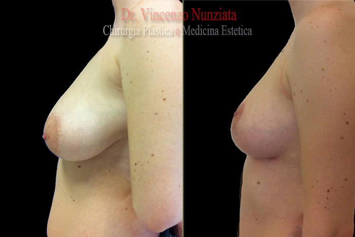 Mastopessi prima e dopo – Paziente 3 – Dr. Vincenzo Nunziata, chirurgo plastico – foto 2