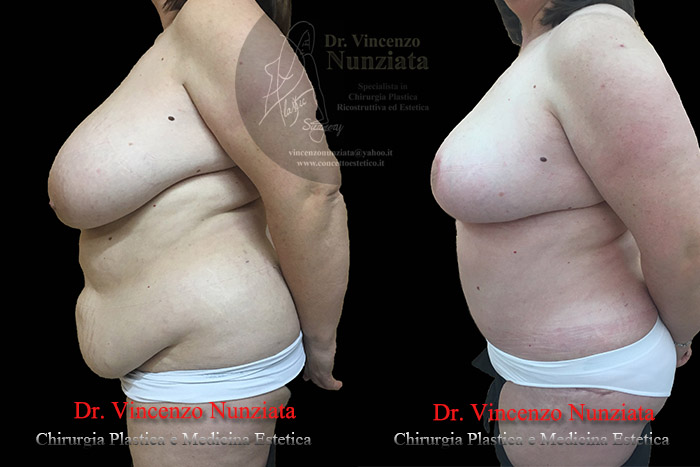 Mastopessi prima e dopo – Paziente 5 – Dr. Vincenzo Nunziata, chirurgo plastico – foto 3