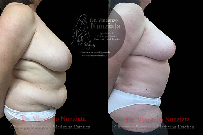 Mastopessi prima e dopo – Paziente 5 – Dr. Vincenzo Nunziata, chirurgo plastico – foto 2