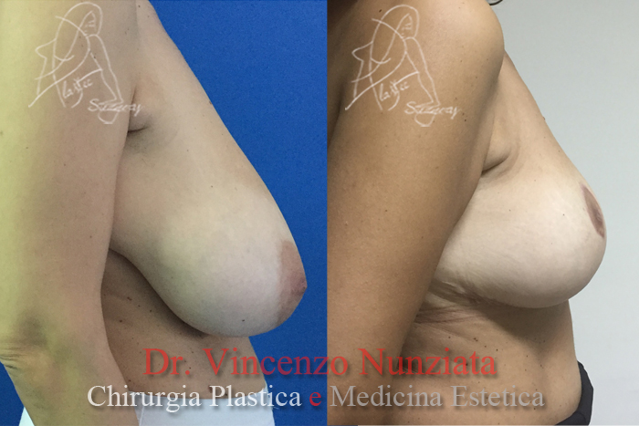 Mastopessi prima e dopo – Paziente 4 – Dr. Vincenzo Nunziata, chirurgo plastico – foto 3