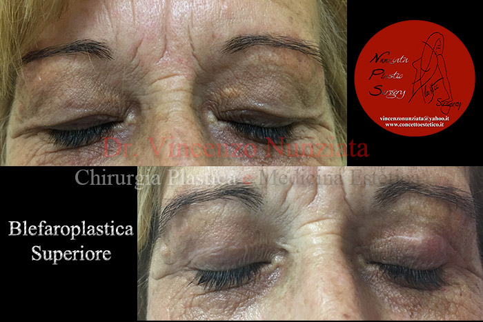 Blefaroplastica prima e dopo – Paziente 6 – Dr. Vincenzo Nunziata, chirurgo plastico – foto 2