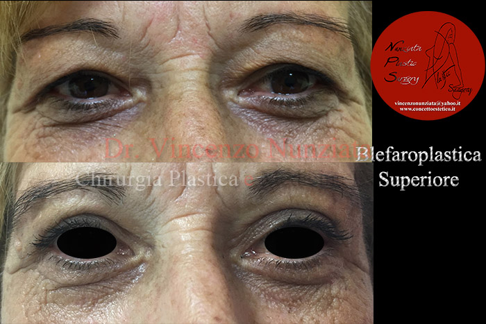 Blefaroplastica prima e dopo – Paziente 6 – Dr. Vincenzo Nunziata, chirurgo plastico – foto 1