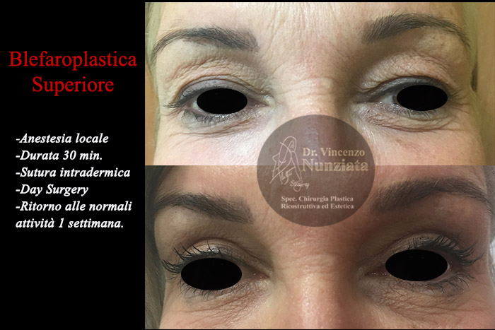 Blefaroplastica prima e dopo – Paziente 5 – Dr. Vincenzo Nunziata, chirurgo plastico – foto 1