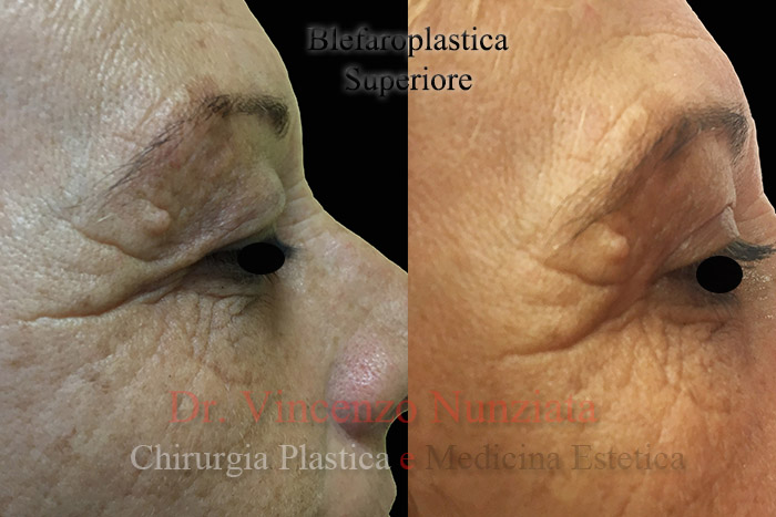 Blefaroplastica prima e dopo – Paziente 6 – Dr. Vincenzo Nunziata, chirurgo plastico – foto 4