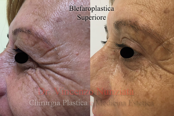 Blefaroplastica prima e dopo – Paziente 6 – Dr. Vincenzo Nunziata, chirurgo plastico – foto 3