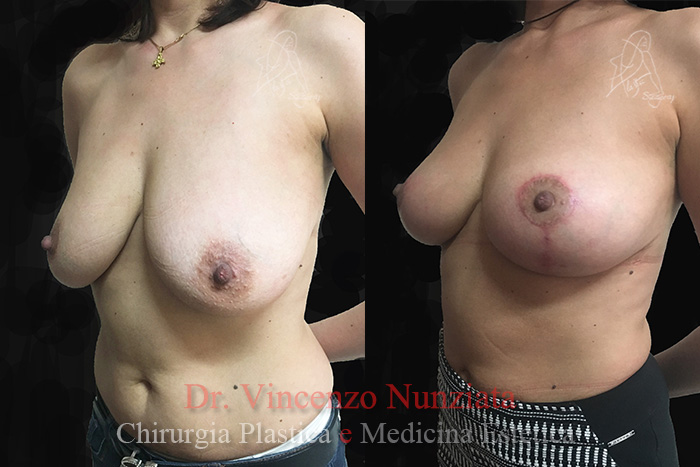 Mastopessi prima e dopo – Paziente 1 – Dr. Vincenzo Nunziata, chirurgo plastico – foto 2
