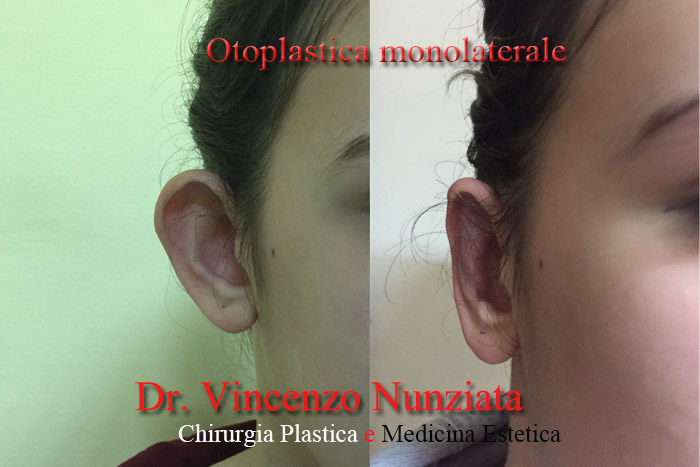 Otoplastica prima e dopo – Paziente 1 – Dr. Vincenzo Nunziata, chirurgo plastico