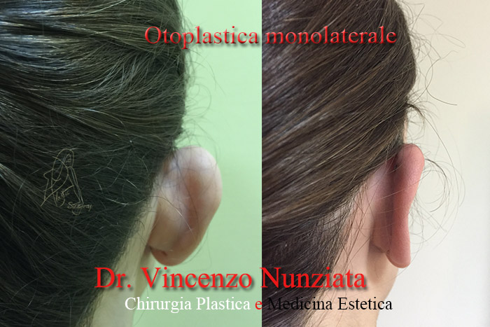 Otoplastica prima e dopo – Paziente 1 – Dr. Vincenzo Nunziata, chirurgo plastico – foto 2