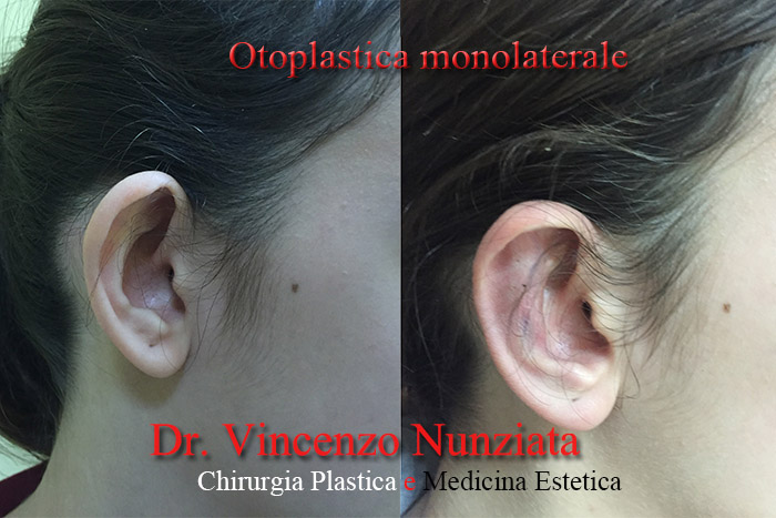 Otoplastica prima e dopo – Paziente 1 – Dr. Vincenzo Nunziata, chirurgo plastico – foto 3