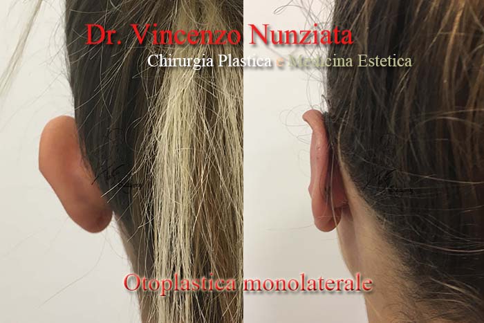 Otoplastica prima e dopo – Paziente 3 – Dr. Vincenzo Nunziata, chirurgo plastico