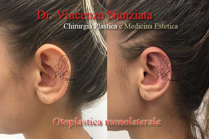 Otoplastica prima e dopo – Paziente 3 – Dr. Vincenzo Nunziata, chirurgo plastico – foto 2