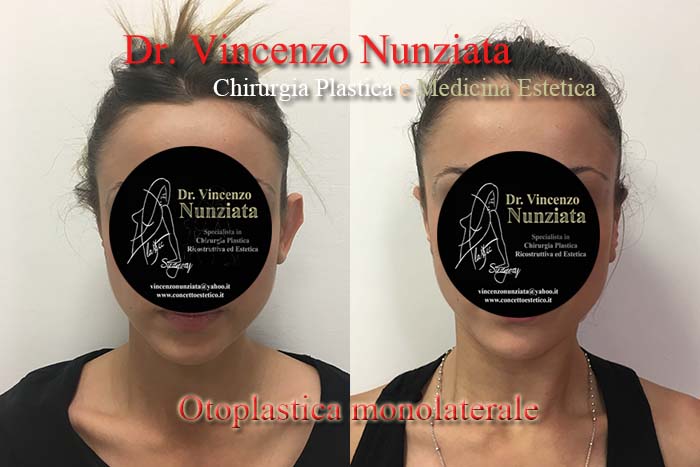 Otoplastica prima e dopo – Paziente 3 – Dr. Vincenzo Nunziata, chirurgo plastico – foto 3
