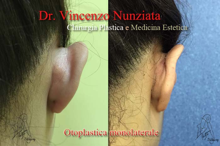 Otoplastica prima e dopo – Paziente 2 – Dr. Vincenzo Nunziata, chirurgo plastico