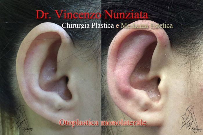 Otoplastica prima e dopo – Paziente 2 – Dr. Vincenzo Nunziata, chirurgo plastico – foto 2