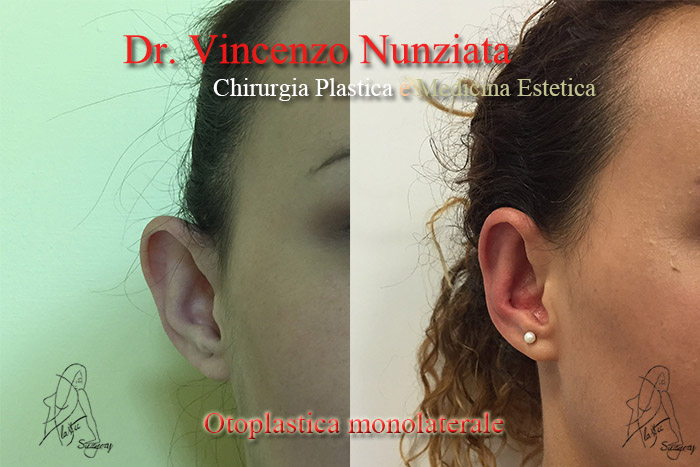 Otoplastica prima e dopo – Paziente 2 – Dr. Vincenzo Nunziata, chirurgo plastico – foto 3