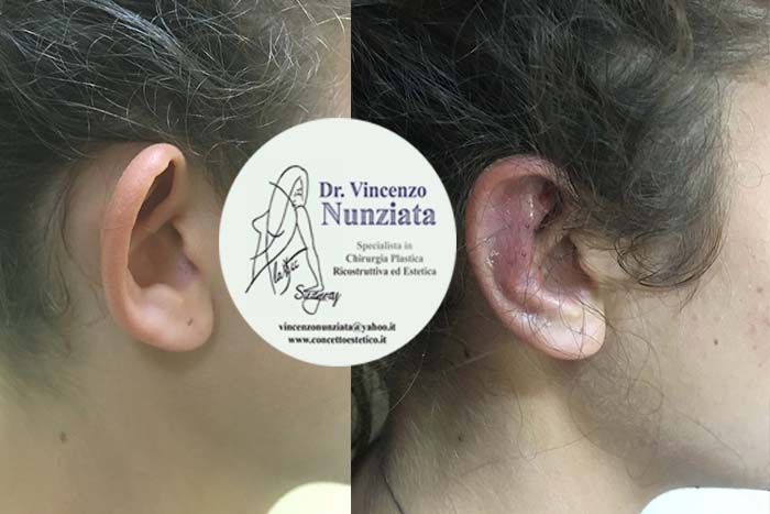 Otoplastica prima e dopo – Paziente 4 – Dr. Vincenzo Nunziata, chirurgo plastico – foto 3