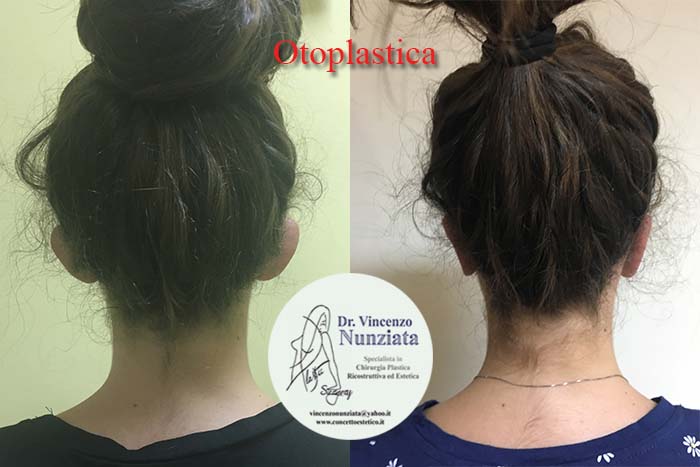 Otoplastica prima e dopo – Paziente 4 – Dr. Vincenzo Nunziata, chirurgo plastico – foto 2