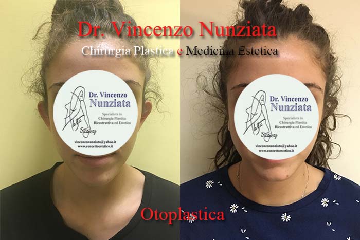 Otoplastica prima e dopo – Paziente 4 – Dr. Vincenzo Nunziata, chirurgo plastico