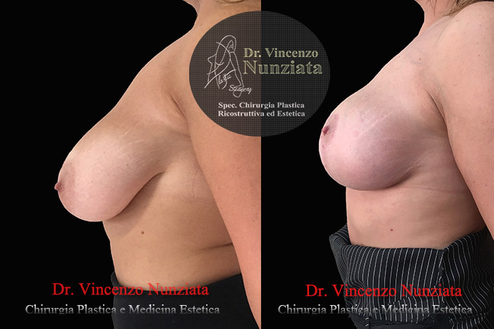 Mastopessi prima e dopo – Paziente 6 – Dr. Vincenzo Nunziata, chirurgo plastico – foto 3