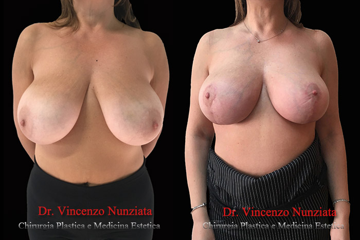 Mastopessi prima e dopo – Paziente 6 – Dr. Vincenzo Nunziata, chirurgo plastico – foto 4