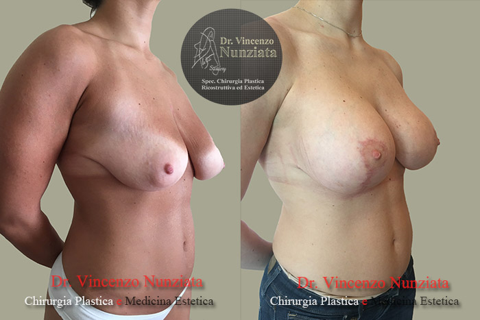 Asimmetrie mammarie prima e dopo – Paziente 3 – Dr. Vincenzo Nunziata, chirurgo plastico – foto 3