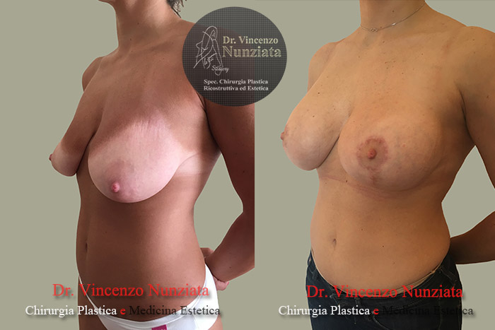 Asimmetrie mammarie prima e dopo – Paziente 3 – Dr. Vincenzo Nunziata, chirurgo plastico – foto 2