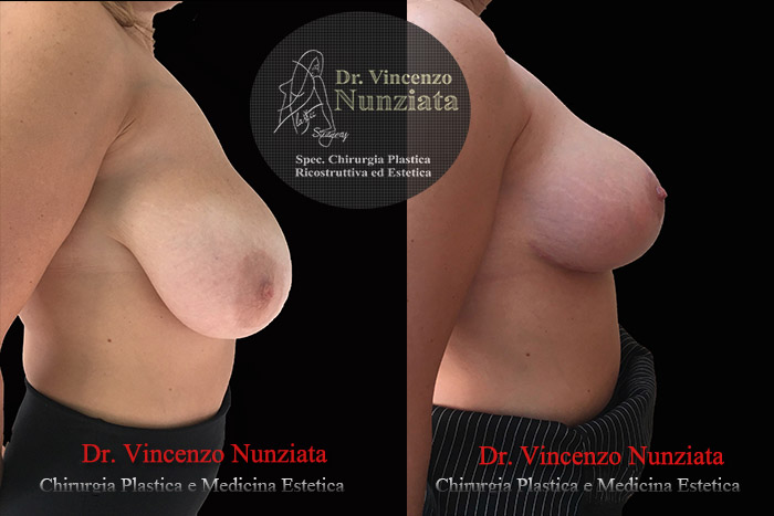 Mastopessi prima e dopo – Paziente 6 – Dr. Vincenzo Nunziata, chirurgo plastico – foto 2