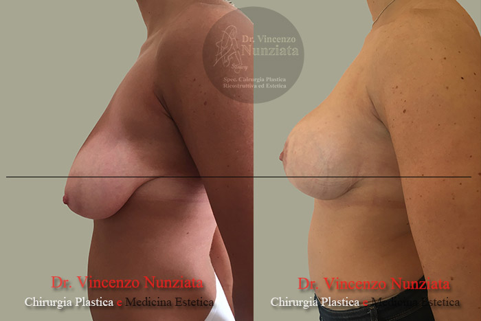 Asimmetrie mammarie prima e dopo – Paziente 3 – Dr. Vincenzo Nunziata, chirurgo plastico – foto 4