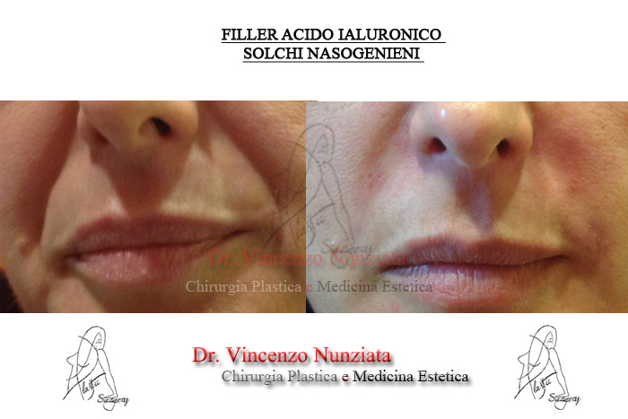 Fillers prima e dopo – Filler rughe – Dr. Vincenzo Nunziata, chirurgo plastico