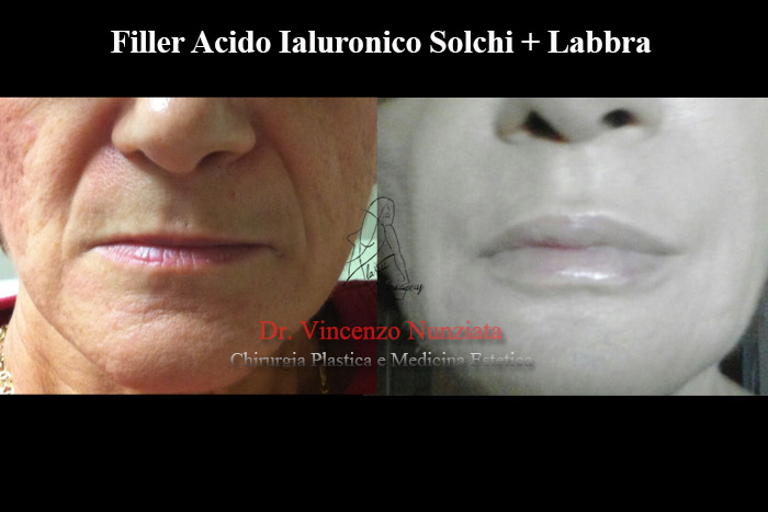 Fillers prima e dopo – Filler rughe – Dr. Vincenzo Nunziata, chirurgo plastico – foto 3