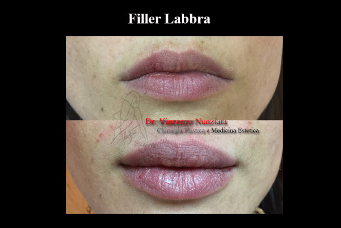 Fillers prima e dopo – Filler Labbra – Dr. Vincenzo Nunziata, chirurgo plastico – foto 6