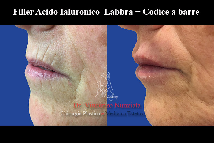 Fillers prima e dopo – Filler Labbra – Dr. Vincenzo Nunziata, chirurgo plastico – foto 7