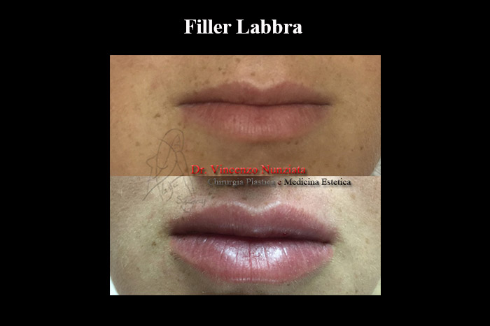 Fillers prima e dopo – Filler Labbra – Dr. Vincenzo Nunziata, chirurgo plastico – foto 5