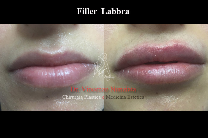Fillers prima e dopo – Filler Labbra – Dr. Vincenzo Nunziata, chirurgo plastico – foto 10