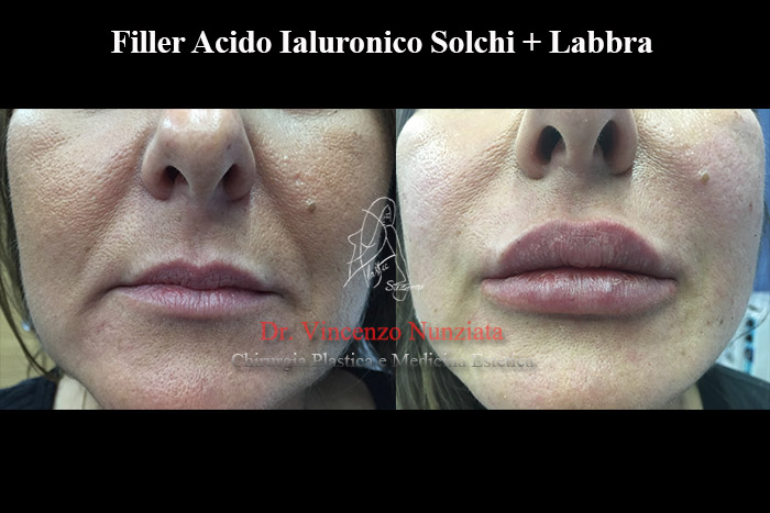 Fillers prima e dopo – Filler Labbra – Dr. Vincenzo Nunziata, chirurgo plastico – foto 11